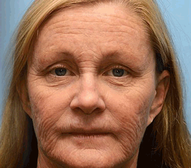 (Made and Shipped from USA) 🧑‍⚕️TLOPA® Botox Bee Venom Wrinkle Removal Cream- LAST DAY 70% OFF🔥